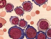 自身免疫性溶血性贫血能治愈吗,治愈之路与希望之光